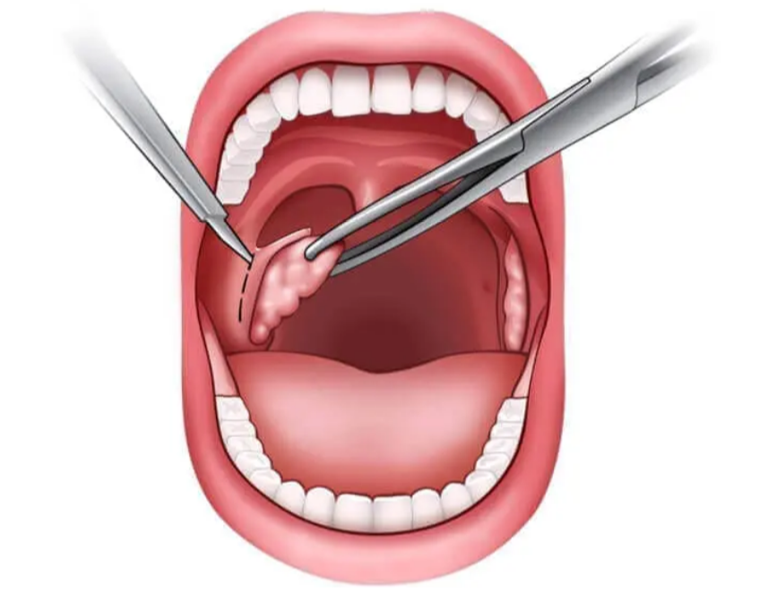 علاج اللوز جراحيًا